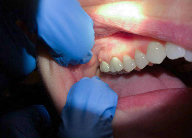 Best Dentist for Tooth Abscess  in Reading, PA